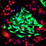 image - Lung cancer cells (green) cultured together with normal lung cells (red). The triple-antibody combination EGFR, HER2 and HER3 strongly impairs the survival of tumor cells while sparing normal cells